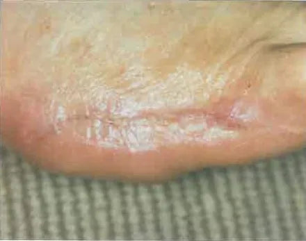 John Casey's Diabetic Foot Wound Recovery