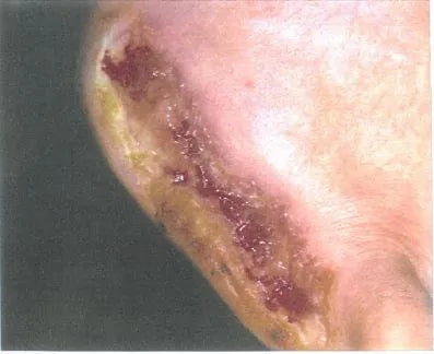 John Casey's Diabetic Foot Wound Recovery