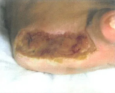 John Casey's Diabetic Foot Wound Recovery