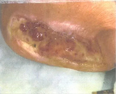 John Casey's Diabetic Foot Wound Recovery