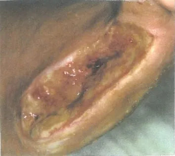 John Casey's Diabetic Foot Wound Recovery