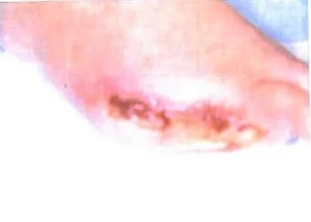 John Casey's Diabetic Foot Wound Recovery