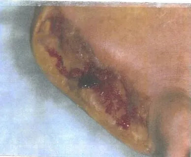John Casey's Diabetic Foot Wound Recovery