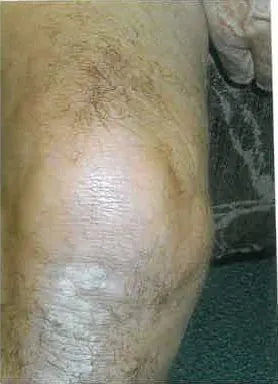 Knee Psoriasis After 20 Years