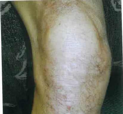 Knee Psoriasis After 20 Years
