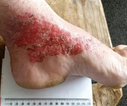 Laura's 7-Year Foot Wound