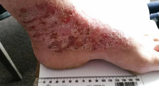 Laura's 7-Year Foot Wound