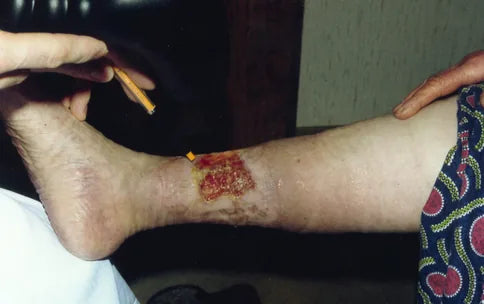 Leg Ulcer: 4-Month Photo Series