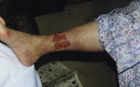 Leg Ulcer: 4-Month Photo Series
