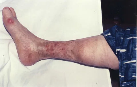Leg Ulcer: 4-Month Photo Series