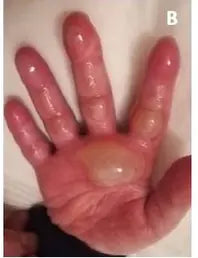 Little Girl’s Hand Burn: 2-Week Photo Series