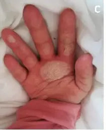 Little Girl’s Hand Burn: 2-Week Photo Series
