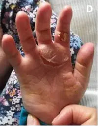 Little Girl’s Hand Burn: 2-Week Photo Series