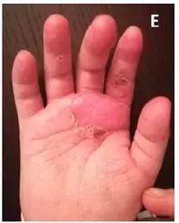 Little Girl’s Hand Burn: 2-Week Photo Series