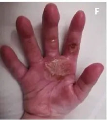 Little Girl’s Hand Burn: 2-Week Photo Series