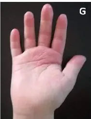 Little Girl’s Hand Burn: 2-Week Photo Series