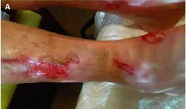 Long-Term Leg Ulcers: Photo Progression