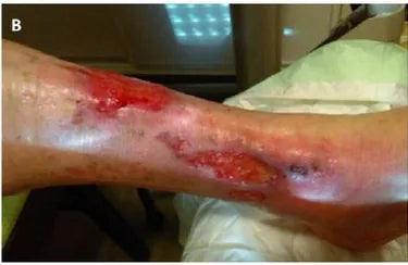 Long-Term Leg Ulcers: Photo Progression