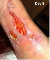 Long-Term Leg Ulcers: Photo Progression