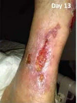 Long-Term Leg Ulcers: Photo Progression