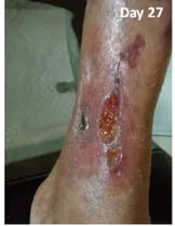Long-Term Leg Ulcers: Photo Progression