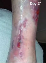 Long-Term Leg Ulcers: Photo Progression