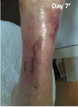 Long-Term Leg Ulcers: Photo Progression