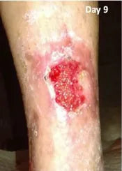 Long-Term Leg Ulcers: Photo Progression