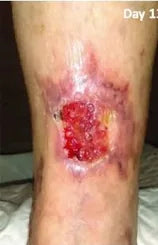 Long-Term Leg Ulcers: Photo Progression
