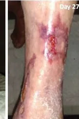 Long-Term Leg Ulcers: Photo Progression