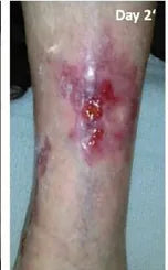 Long-Term Leg Ulcers: Photo Progression