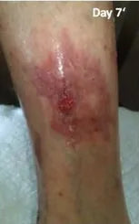 Long-Term Leg Ulcers: Photo Progression