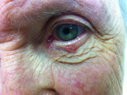 Macular Degeneration: 3-Week Progress