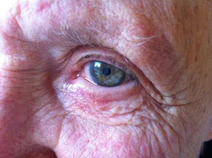 Macular Degeneration: 3-Week Progress