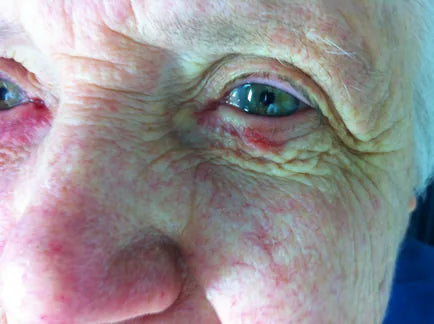 Macular Degeneration: 3-Week Progress