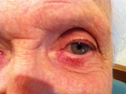 Macular Degeneration: 3-Week Progress