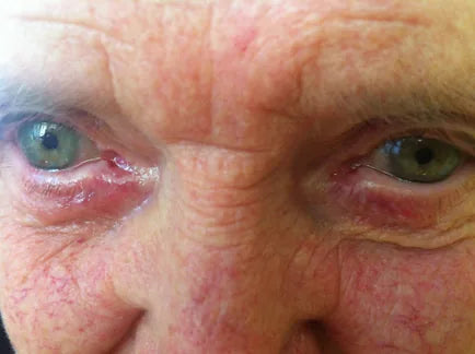 Macular Degeneration: 3-Week Progress