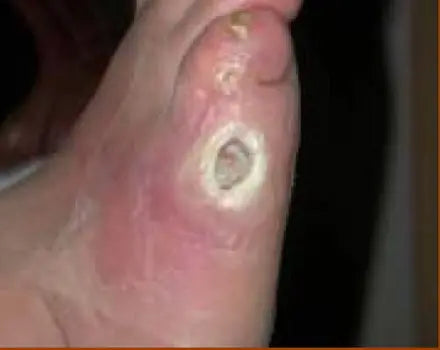 Non-Healing Diabetic Foot Burn Wound