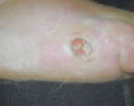 Non-Healing Diabetic Foot Burn Wound
