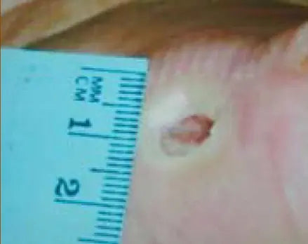Non-Healing Diabetic Foot Burn Wound