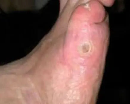 Non-Healing Diabetic Foot Burn Wound