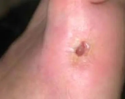 Non-Healing Diabetic Foot Burn Wound