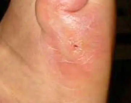 Non-Healing Diabetic Foot Burn Wound