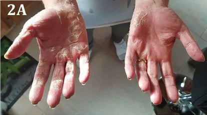 Psoriasis of the Hands and Feet