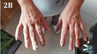 Psoriasis of the Hands and Feet