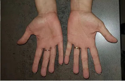 Psoriasis of the Hands and Feet