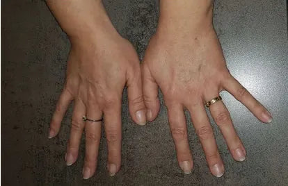 Psoriasis of the Hands and Feet
