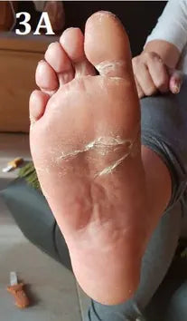Psoriasis of the Hands and Feet