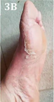 Psoriasis of the Hands and Feet