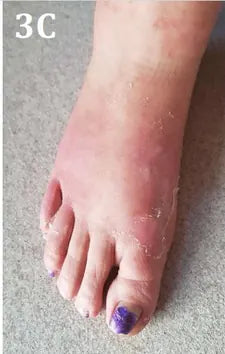 Psoriasis of the Hands and Feet